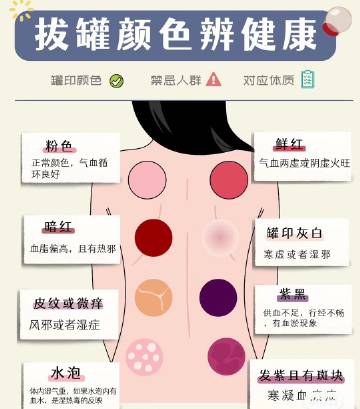 揭秘拔罐颜色的真相，颜色深浅并非体内毒素堆积的证据