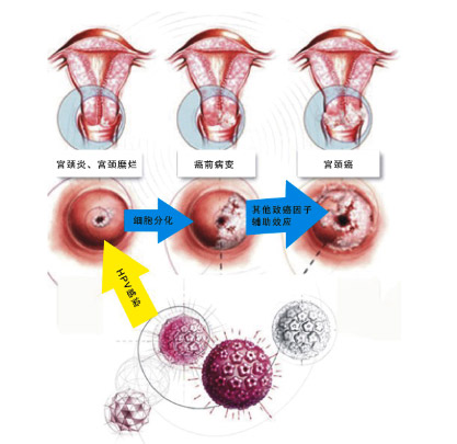 从HPV感染到宫颈癌，5步之遥